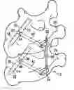 Fig. 01 - Vertebral stabilization assembly and method
