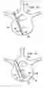 Fig. 09 - Vertebral stabilization assembly and method