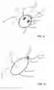 Fig. 02 - Device and system for anchoring tissue to bone