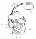 Fig. 01 - Implantable cardiac stimulator
