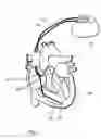 Fig. 02 - Implantable cardiac stimulator