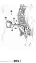 Fig. 02 - Method of use of implantable percutaneous stimulation lead