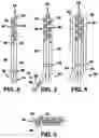 Fig. 03 - Method of use of implantable percutaneous stimulation lead