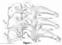 Fig. 02 - Artificial spinal disc