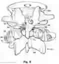 Fig. 04 - Prostheses, Tools And Methods For Replacement Of Natural Facet Joints With Artificial Facet Joint Surfaces