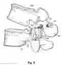 Fig. 05 - Prostheses, Tools And Methods For Replacement Of Natural Facet Joints With Artificial Facet Joint Surfaces