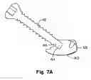 Fig. 07 - Prostheses, Tools And Methods For Replacement Of Natural Facet Joints With Artificial Facet Joint Surfaces