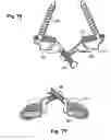 Fig. 09 - Prostheses, Tools And Methods For Replacement Of Natural Facet Joints With Artificial Facet Joint Surfaces