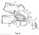 Fig. 14 - Prostheses, Tools And Methods For Replacement Of Natural Facet Joints With Artificial Facet Joint Surfaces