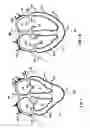 Fig. 02 - Delivery of cardiac constraint jacket
