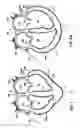 Fig. 03 - Delivery of cardiac constraint jacket