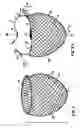 Fig. 04 - Delivery of cardiac constraint jacket