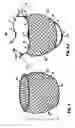 Fig. 05 - Delivery of cardiac constraint jacket