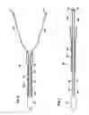 Fig. 07 - Delivery of cardiac constraint jacket