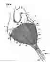 Fig. 08 - Delivery of cardiac constraint jacket