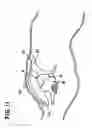 Fig. 10 - Delivery of cardiac constraint jacket