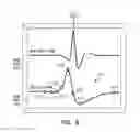Fig. 07 - Cardiac rhythm management systems and methods using multiple morphology templates for discriminating between rhythms