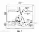 Fig. 08 - Cardiac rhythm management systems and methods using multiple morphology templates for discriminating between rhythms