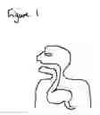 Fig. 02 - Stomach balloon that can be inserted and removed via mouth