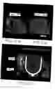 Fig. 13 - Devices and methods for attachment of a gastrointestinal sleeve