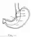 Fig. 14 - Devices and methods for attachment of a gastrointestinal sleeve