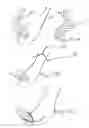 Fig. 15 - Devices and methods for attachment of a gastrointestinal sleeve