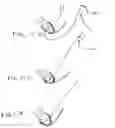 Fig. 16 - Devices and methods for attachment of a gastrointestinal sleeve