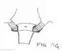 Fig. 17 - Devices and methods for attachment of a gastrointestinal sleeve