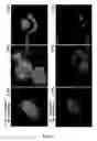 Fig. 16 - Cell permeable nanoconjugates of shell-crosslinked knedel (SCK) and peptide nucleic acids (“PNAs”) with uniquely expressed or over-expressed mRNA targeting sequences for early diagnosis and therapy of cancer