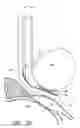 Fig. 52 - Surgical file system with a visualization instrument