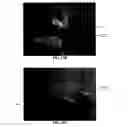 Fig. 24 - Tissue augmentation device