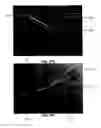 Fig. 27 - Tissue augmentation device