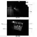Fig. 37 - Tissue augmentation device