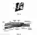Fig. 39 - Tissue augmentation device