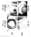 Fig. 02 - Methods and compositions useful for inhibition of alpha v beta 5 mediated angiogenesis
