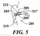 Fig. 06 - Method for treating otitis externa