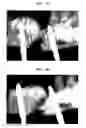 Fig. 06 - Bone-filling composition for stimulating bone-forming and bone-consolidation comprising calcium sulfate and viscous biopolymers