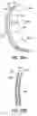 Fig. 49 - Method and apparatus for direct mechanical ventricular actuation with favorable conditioning and minimal heart stress