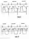 Fig. 09 - External counterpulsation system and method for minimizing end diastolic pressure