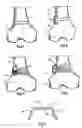Fig. 02 - Bone staple and methods for correcting spine disorders