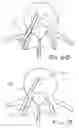 Fig. 09 - Bone staple and methods for correcting spine disorders