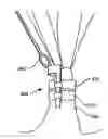 Fig. 01 - Apparatus and method for elongation of a papillary muscle