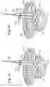 Fig. 09 - Minimal access lumbar diskectomy instrumentation and method
