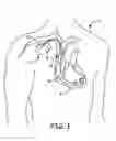 Fig. 02 - Implantable medical device with ventricular pacing protocol including progressive conduction search