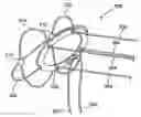 Fig. 01 - Spinal disc annulus reconstruction method and deformable spinal disc annulus stent