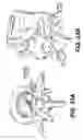 Fig. 22 - Spinal disc annulus reconstruction method and deformable spinal disc annulus stent