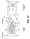 Fig. 23 - Spinal disc annulus reconstruction method and deformable spinal disc annulus stent
