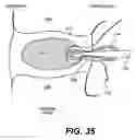 Fig. 24 - Spinal disc annulus reconstruction method and deformable spinal disc annulus stent