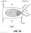 Fig. 25 - Spinal disc annulus reconstruction method and deformable spinal disc annulus stent