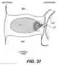 Fig. 26 - Spinal disc annulus reconstruction method and deformable spinal disc annulus stent